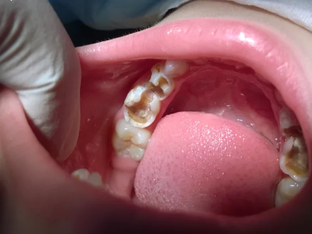 Trường hợp bé có răng sâu vỡ lớn không thể trám